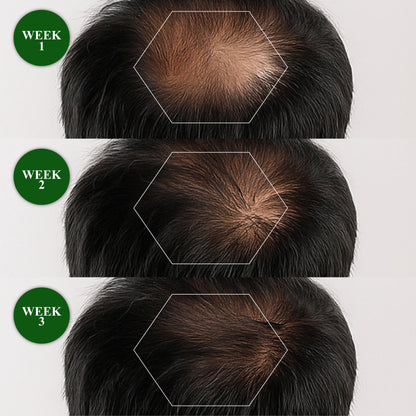 HomeCleanGoods™ ManGro EGCG Microneedle Scalp Essence Kit